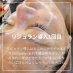 リジュラン導入直後のツヤ_水光ピールスキン